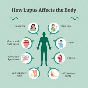 Early Signs and Symptoms of Lupus
