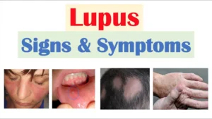 Early Signs and Symptoms of Lupus