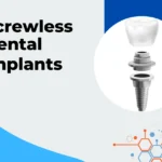 Screwless Dental Implants for Seniors